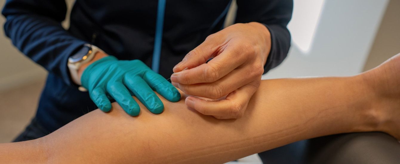 Dry Needling